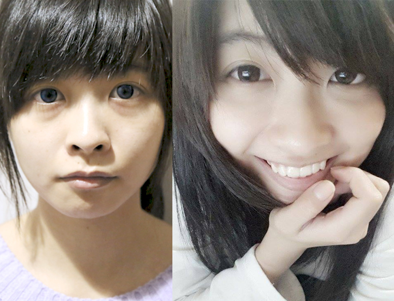 淚溝 黑眼圈 醫學美容